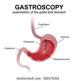 Upper Endoscopy – Dr Loong Yik Yee